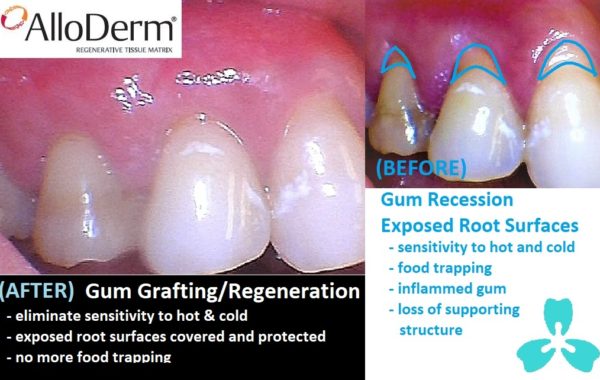 Gum Regeneration  (AlloDerm™)