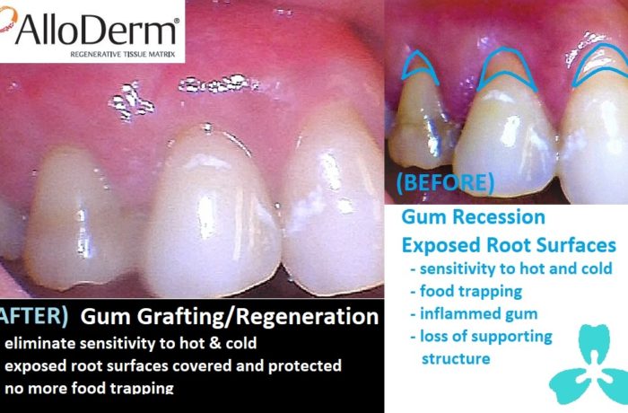 Gum Regeneration  (AlloDerm™)