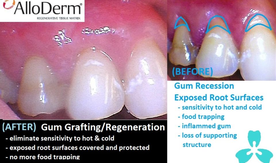 Gum Regeneration  (AlloDerm™)