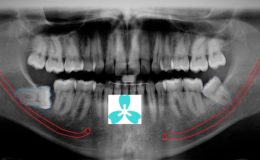 Horizontally Impacted Wisdom Teeth