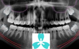 Impacted Wisdom Teeth early intervention final