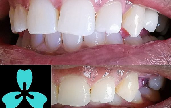 Single Tooth Replacement with Bone Grafting and Implant Supported Crown