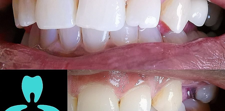 Single Tooth Replacement with Bone Grafting and Implant Supported Crown