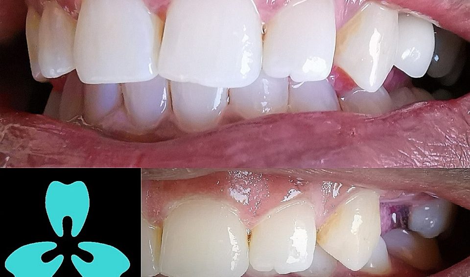 Single Tooth Replacement with Bone Grafting and Implant Supported Crown