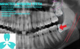 WISDOM TEETH painless extraction removal less or no swelling GTA North York Scaborough Dentsit