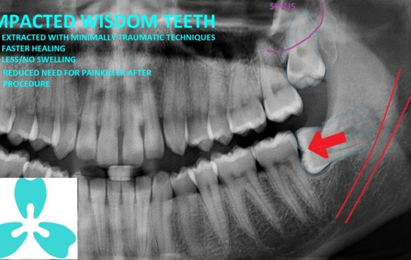 Wisdom Teeth Extraction (Minimally Traumatic Technique)