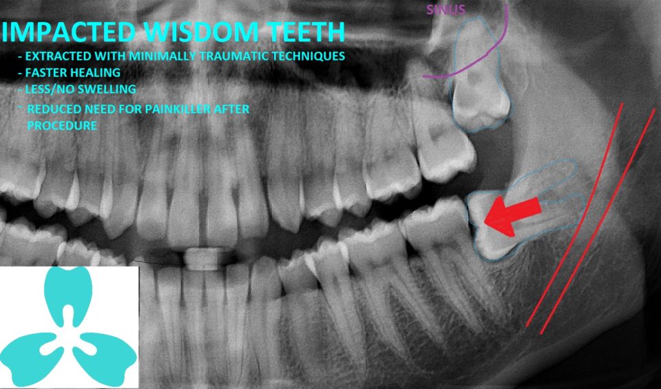 Wisdom Teeth Extraction (Minimally Traumatic Technique)