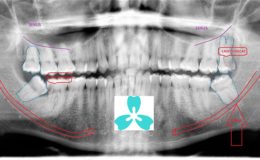 Wisdom Teeth Late Removal Consquences