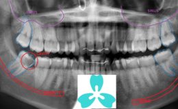 Wisdom Teeth Late Removal Middle Age Consequeces