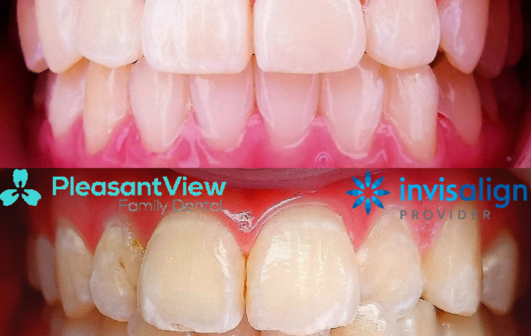 Invisalign Teen