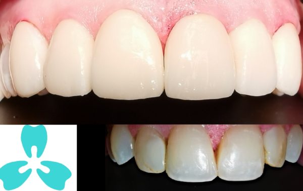 Emax® Porcelain Veneer – Perfect Confident Smile in No Time
