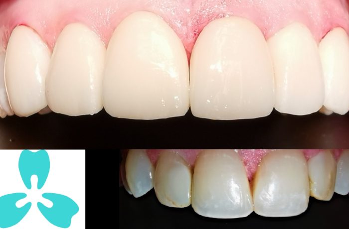 Emax® Porcelain Veneer – Perfect Confident Smile in No Time