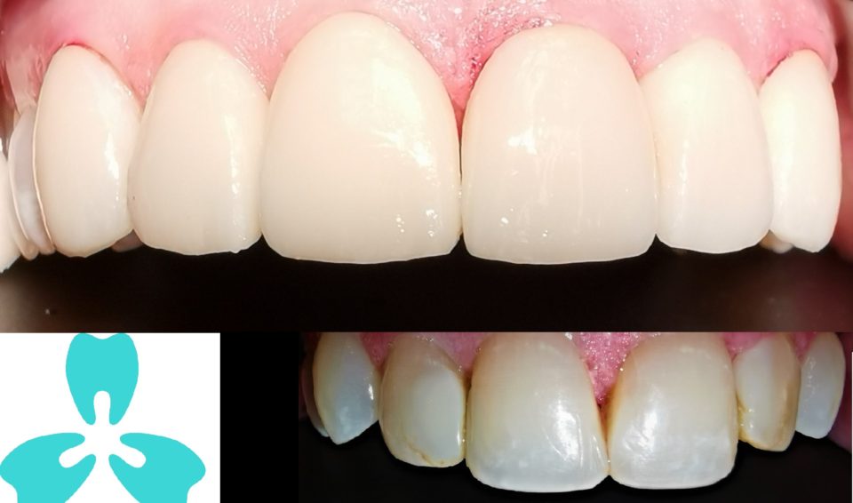 Emax® Porcelain Veneer – Perfect Confident Smile in No Time