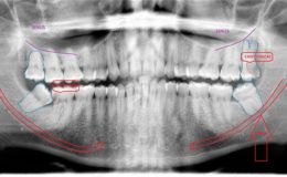 Wisdom Teeth (LATE REMOVAL)